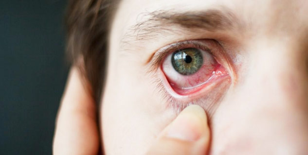eye infection 