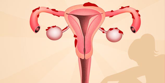 Endometriosis: 7 Myths And Facts Debunked For Women’s Health | OnlyMyHealth