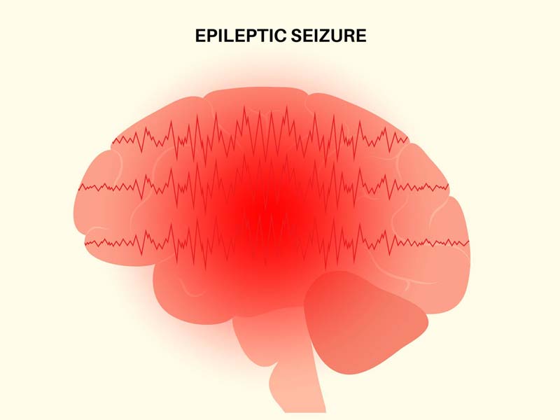 All About Epilepsy In Children: Causes, Types, Diagnosis and Treatment
