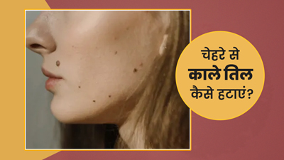 चेहरे पर हैं तिल, तो इन घरेलू उपायों से करें रिमूव