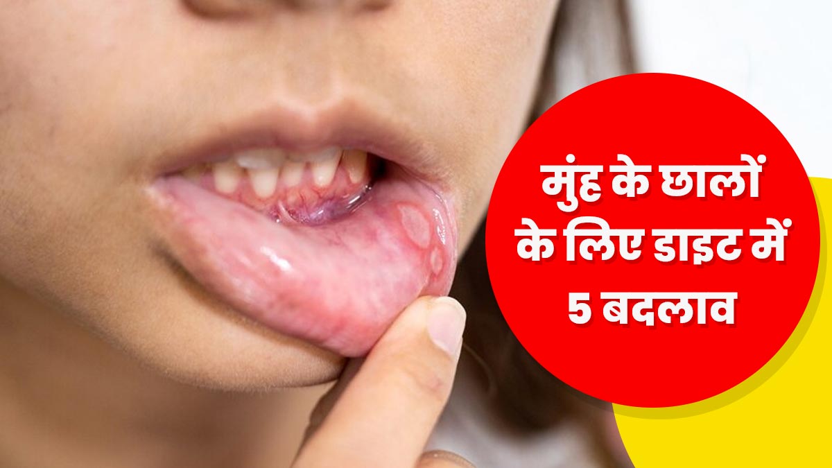 Mouth Ulcers: मुंह में छाले होने पर डाइट में करें ये 5 बदलाव, जल्द मिलेगा आराम