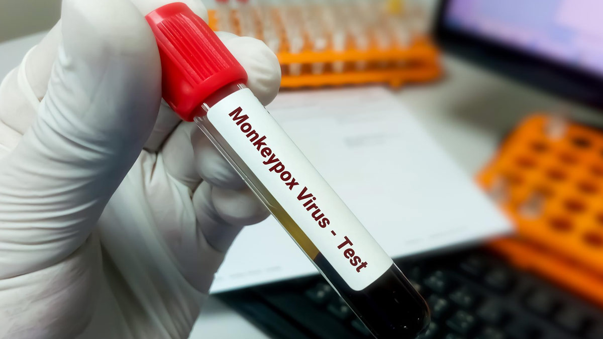Monkeypox Virus Myths Facts