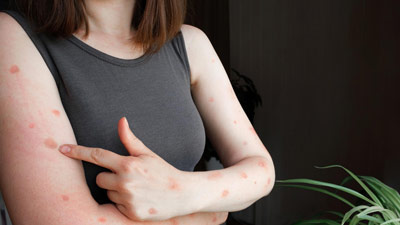 Monkeypox वायरस से जुड़े इन 6 मिथकों पर न करें भरोसा
