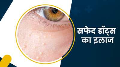 मिट सकते हैं स्किन के सफेद डॉट्स जैसे धब्बे, जानें इलाज