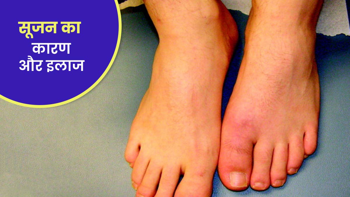 मॉनसून में पैर की उंगल‍ियों में क्‍यों होती है सूजन? जानें कारण और इलाज 