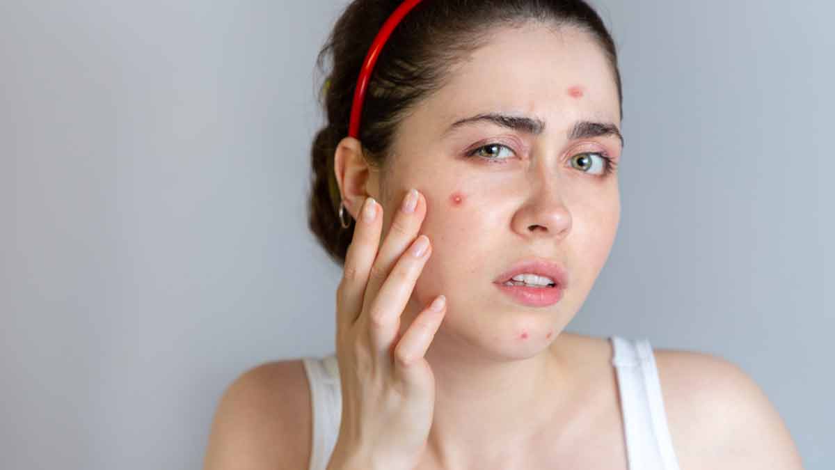 Vitamin Deficiency Causes Acne