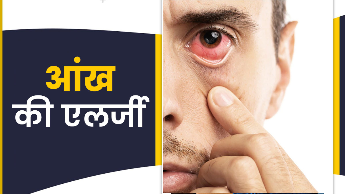 मॉनसून के दौरान आंख की एलर्जी के हो सकते हैं ये लक्षण, जानें इसका इलाज