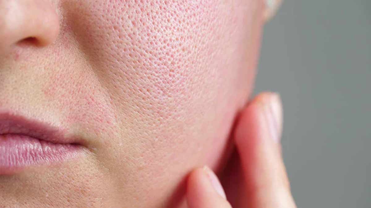 open pores treatment