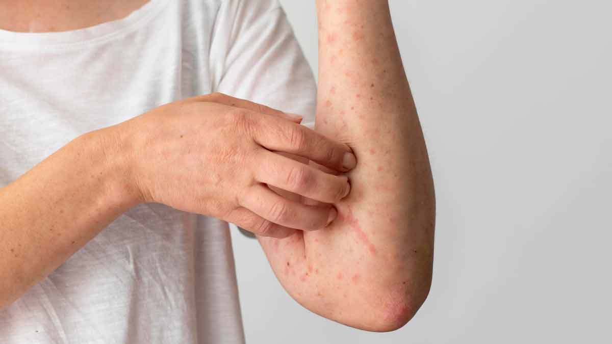 amaltas-benefits-for-skin