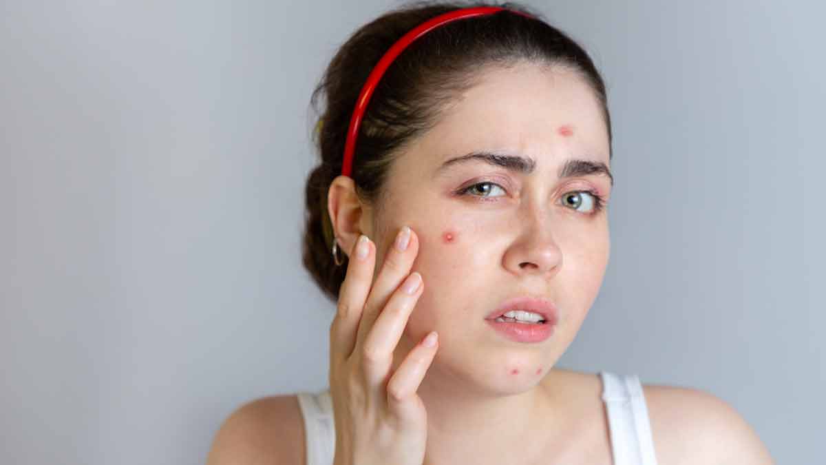 बार-बार होते हैं मुंहासें? छुटकारा पाने के लिए फॉलो करें 4 बातें