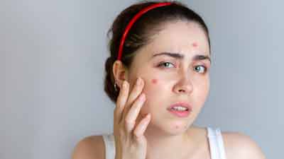 बार-बार होते हैं मुंहासें? छुटकारा पाने के लिए फॉलो करें 4 बातें