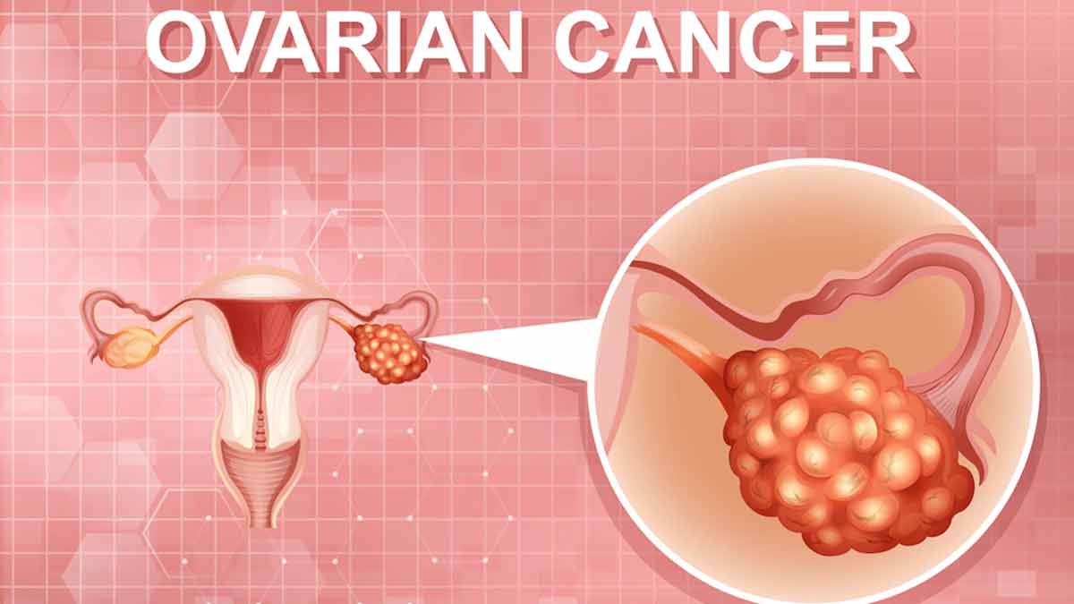 5 Signs of Ovarian Cancer You Should Watch Out For Early Detection