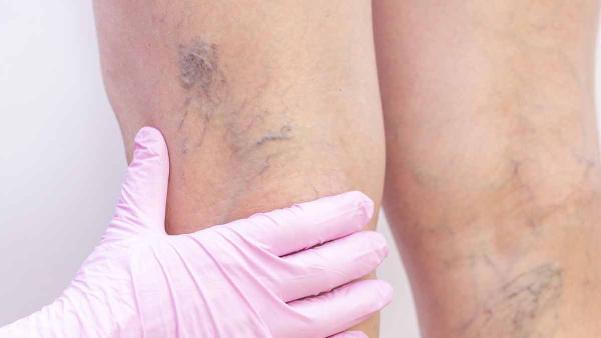 What Causes Varicose Veins During Menopause