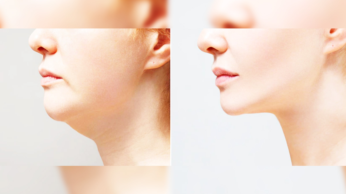 chubby cheeks treatment 