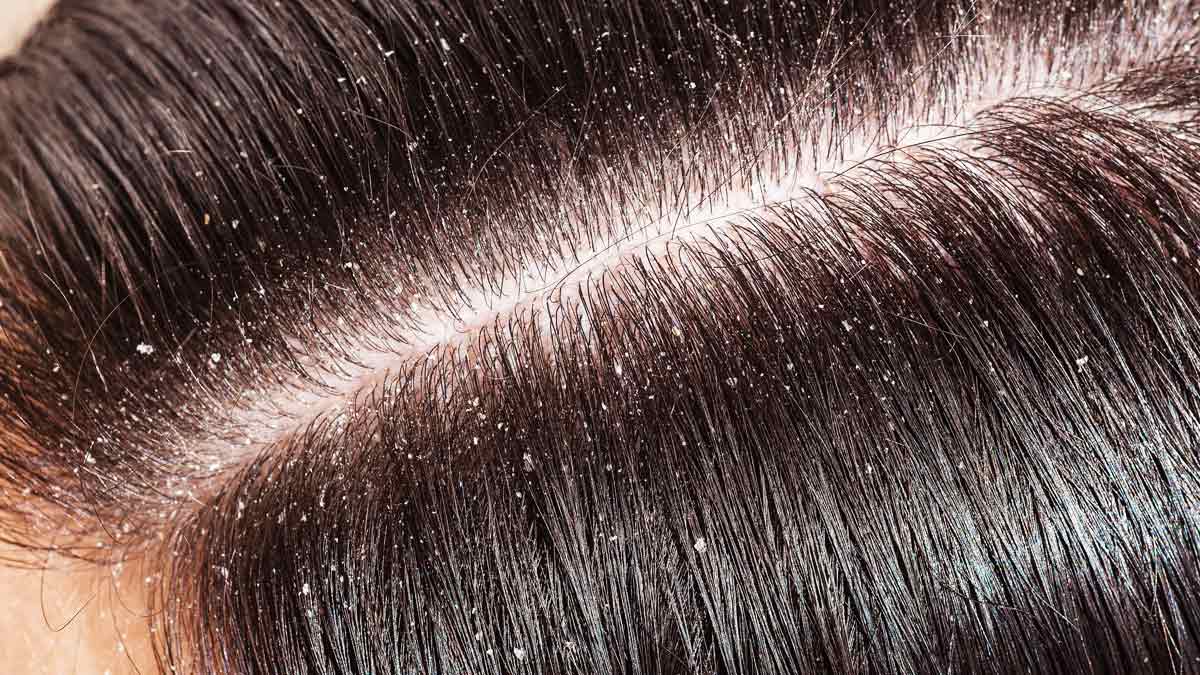 benefits-of-coconut-oil-lemon-for-dandruff