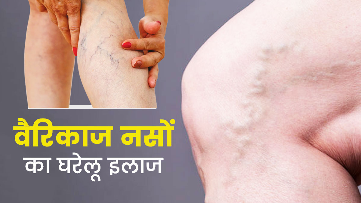 Varicose Vein Therapy: नसों के लिए घातक बनी प्रचंड गर्मी, नर्व्स से जुड़ी बीमारी बढ़ती जा रही है, वैरिकोज वेन्स का योग थेरेपी