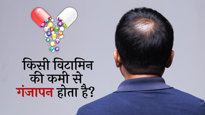 गंजापन किन पोषक तत्वों की कमी से होता है? जानें इनके फूड सोर्स