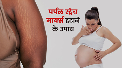 शरीर पर हो गए बैंगनी रंग के स्ट्रेच मार्क्स? हटाने के लिए आजमाएं ये 4 घरेलू नुस्खे