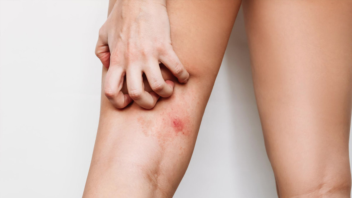 Fungal Infection Inner Thigh Home Remedies