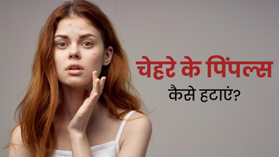 चेहरे के पिंपल्स कैसे हटाएं? जानें 5 घरेलू उपाय
