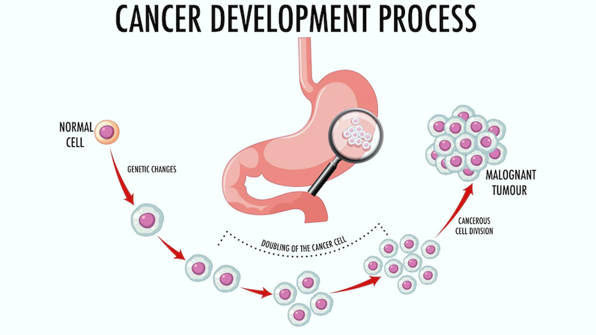 Stomach Cancer Types, Tests For Diagnosis and New Treatments