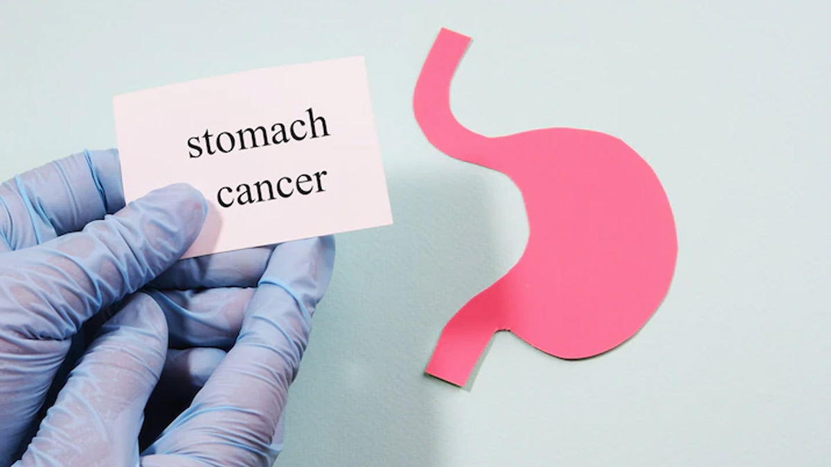 Stomach Cancer: Types, Tests For Diagnosis and New Treatments