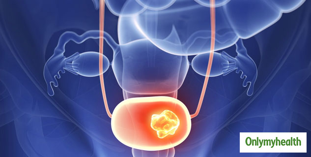 Recent Advances in Diagnosis and Management of Urinary Bladder Cancer 