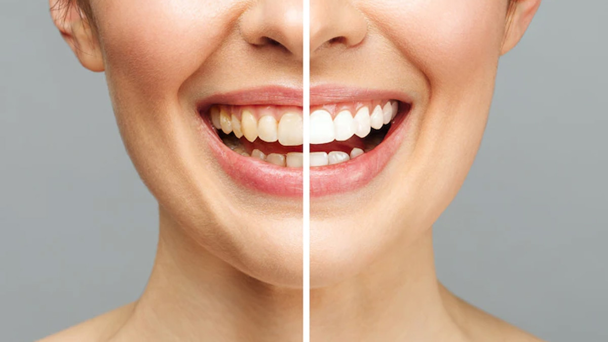 White Teeth Are Not Necessarily Healthy, Here's Why