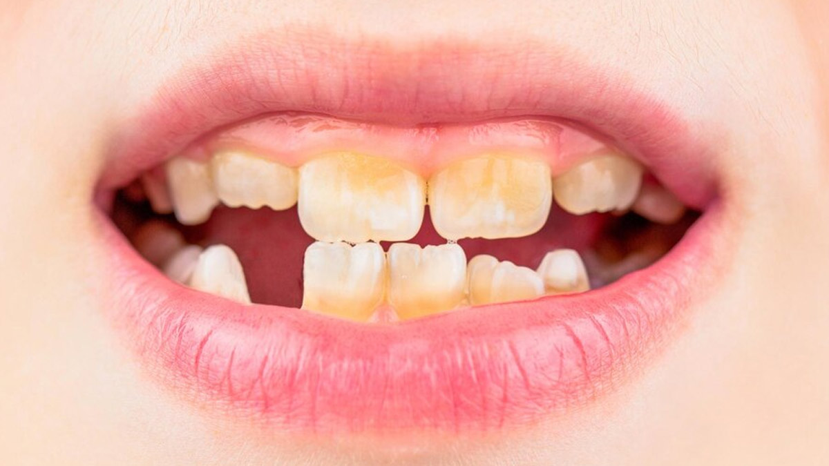 Teeth Stains And What They Mean