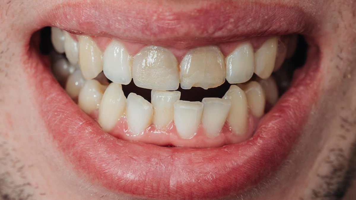 crooked-teeth-how-they-influence-your-oral-health-onlymyhealth