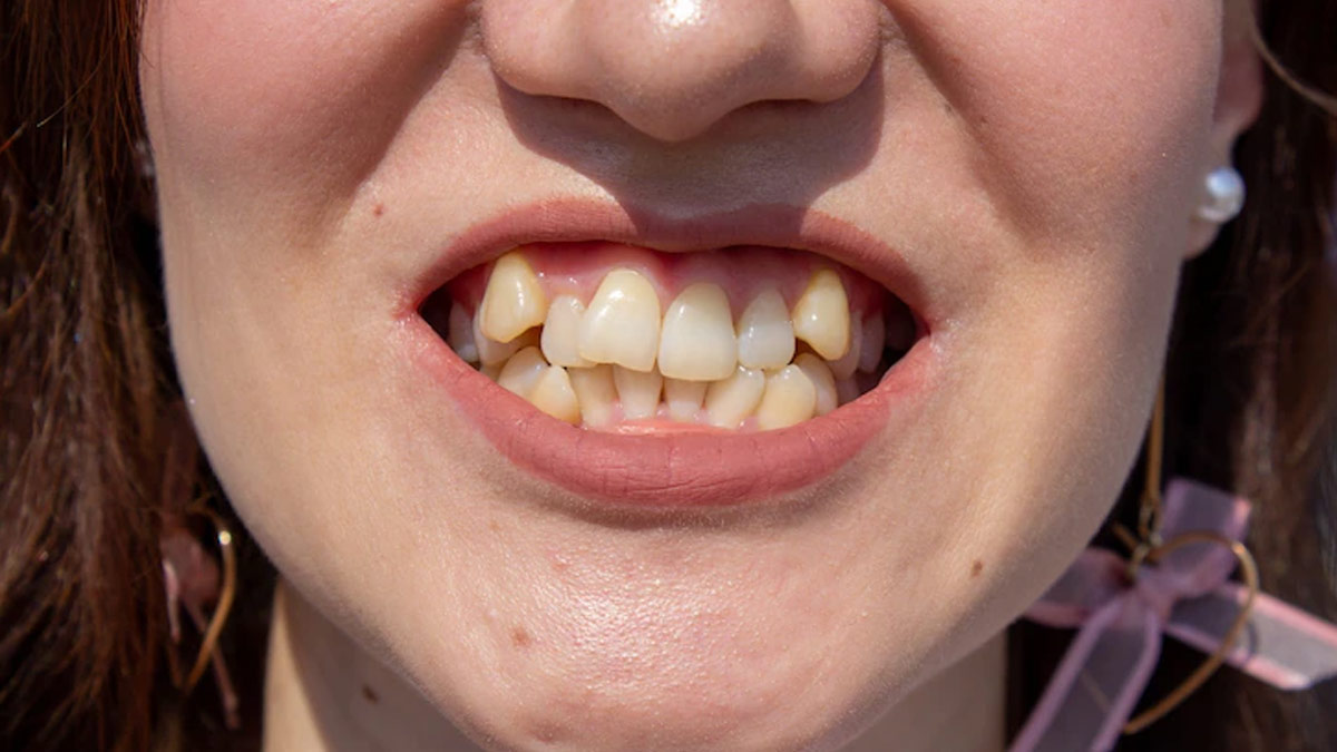 Crooked Teeth: How They Influence Your Oral Health