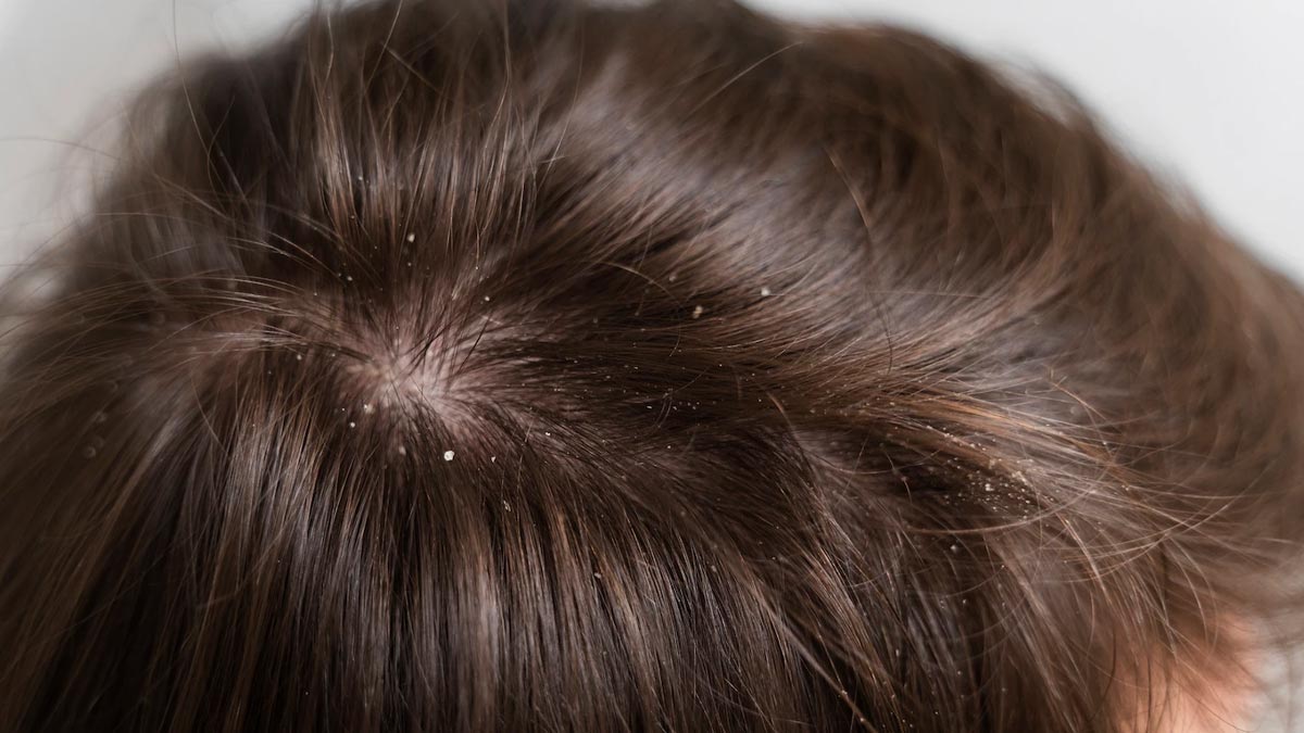 Dandruff During Winters: Learn How To Reduce
