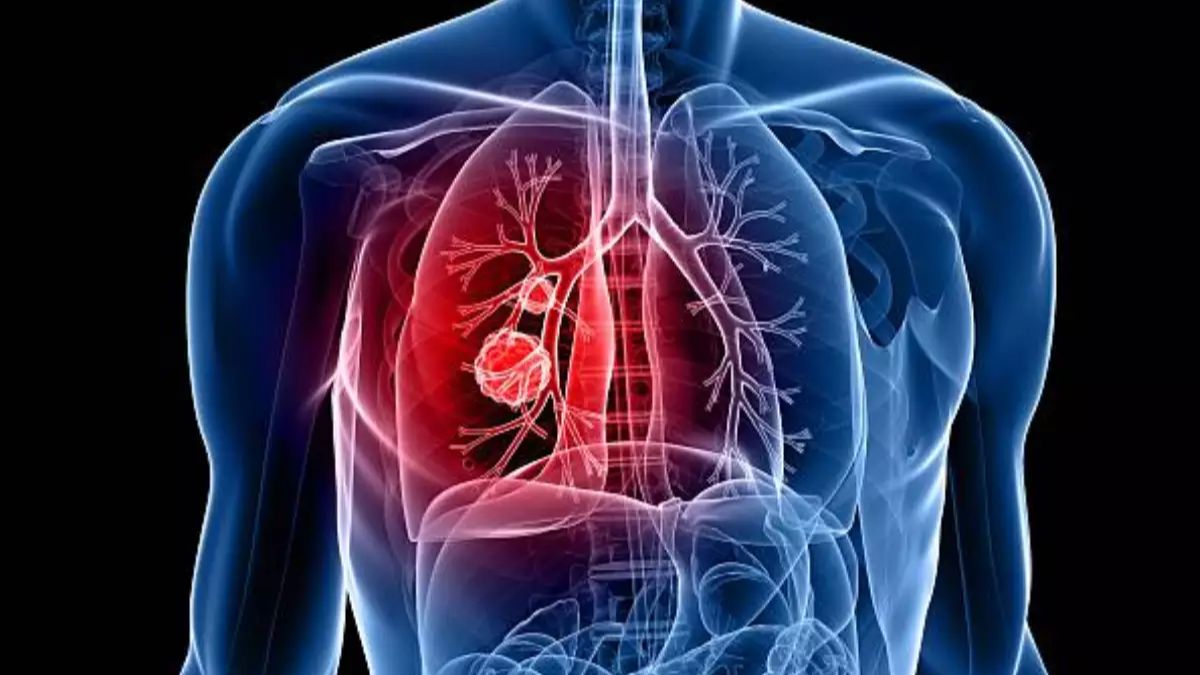 Pleurisy in Hindi