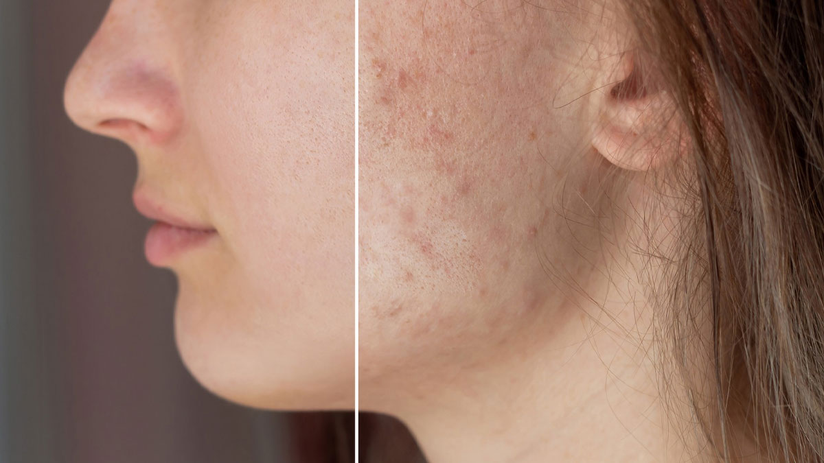 How To Use Orange Peel Powder For Dark Spots