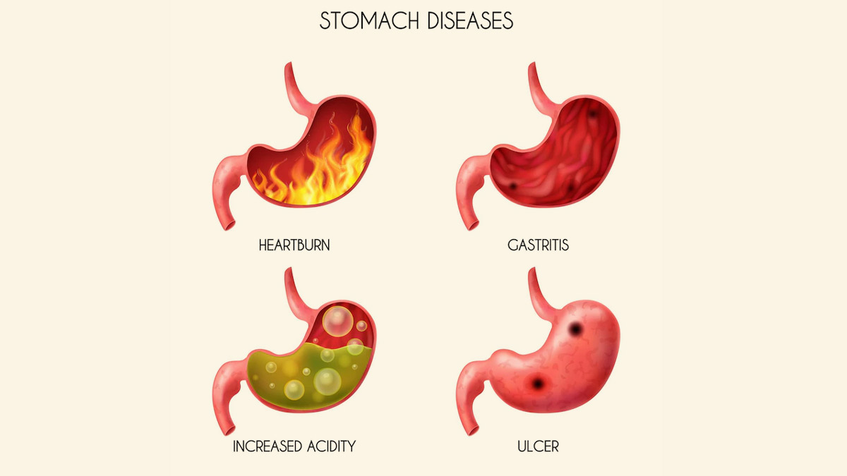 7 Foods To Avoid To Cure Gastric Issues