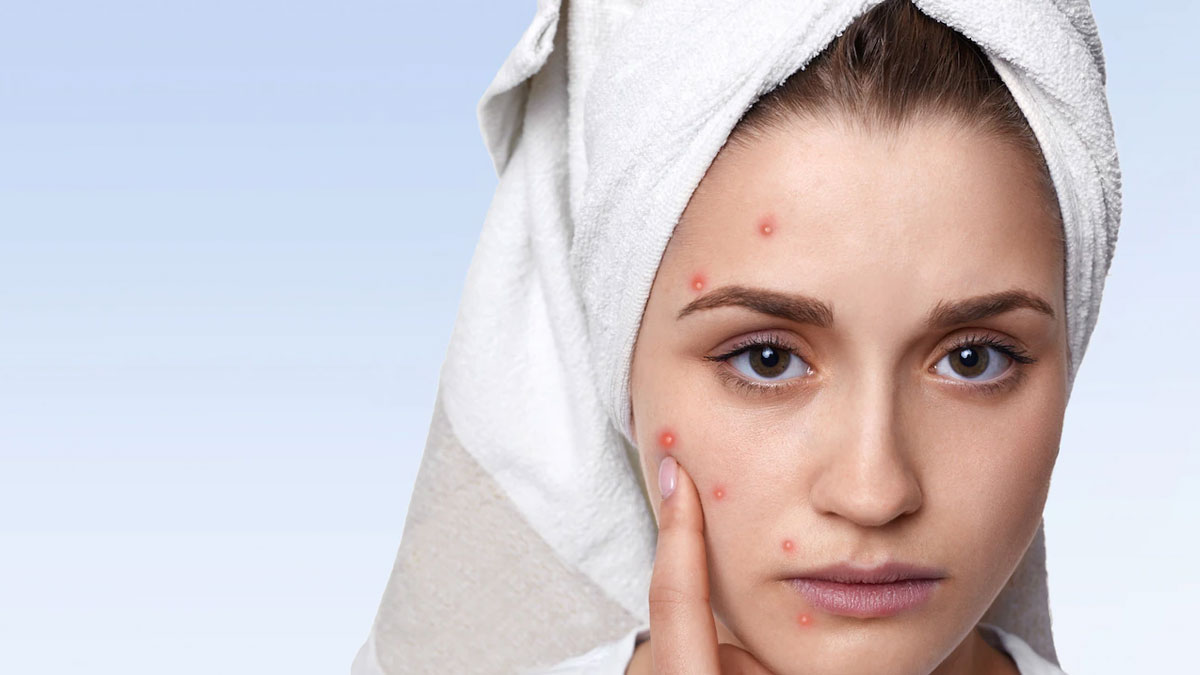 How to use honey for pimples and dark spots