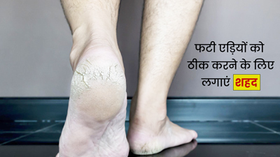 फटी एड़ियों पर लगाएं शहद से बना ये फुट मास्क, कोमल हो जाएंगी एडियां