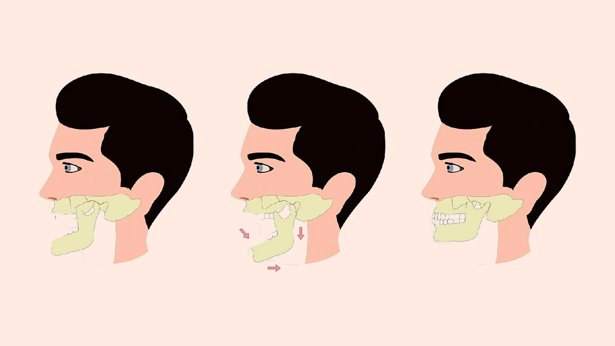 what-to-avoid-if-you-have-tmj-disorder-expert-explains-onlymyhealth