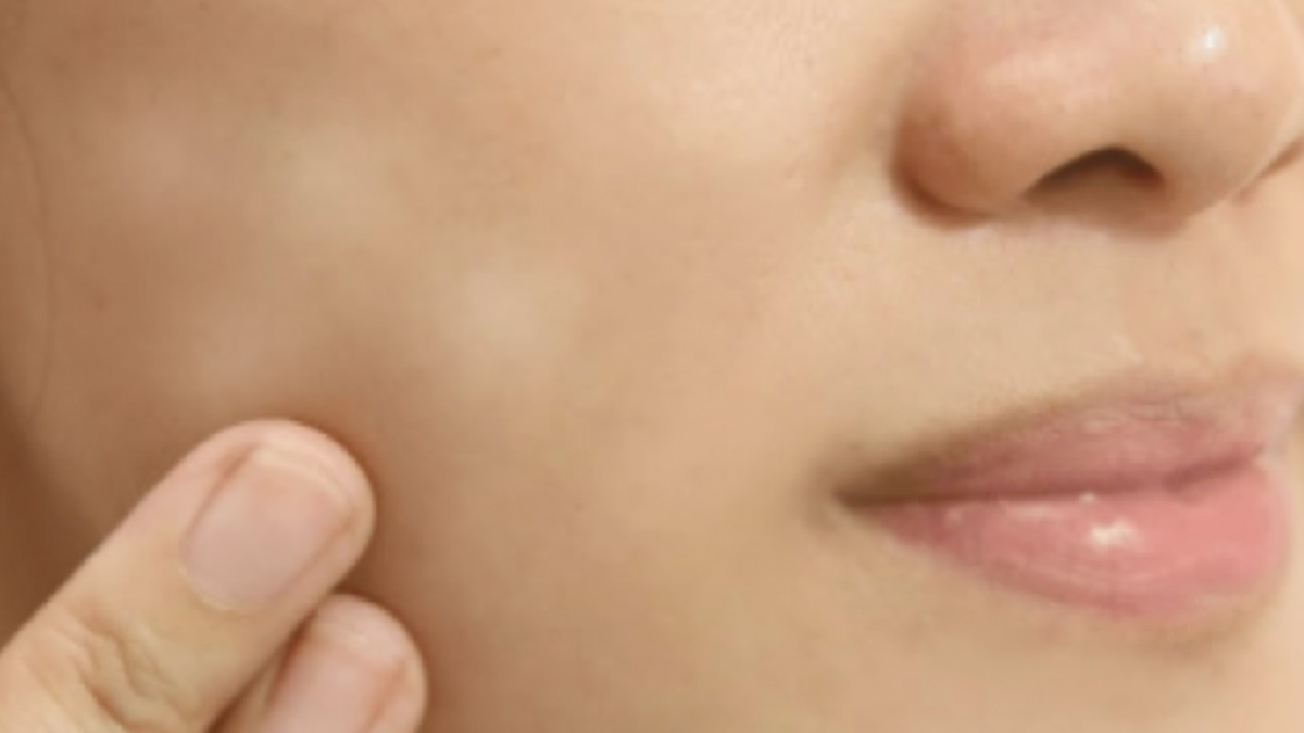 white patches on face