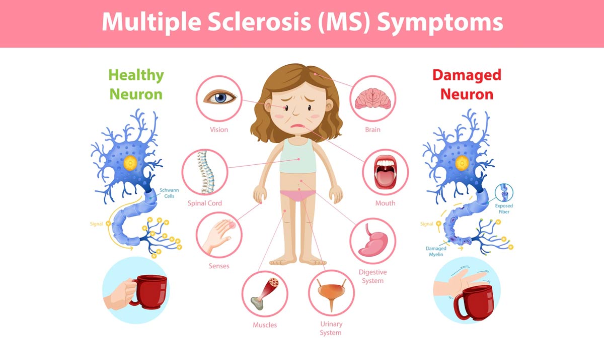 Poor Gut Health May Lead To Multiple Sclerosis, Here’s How To Prevent It