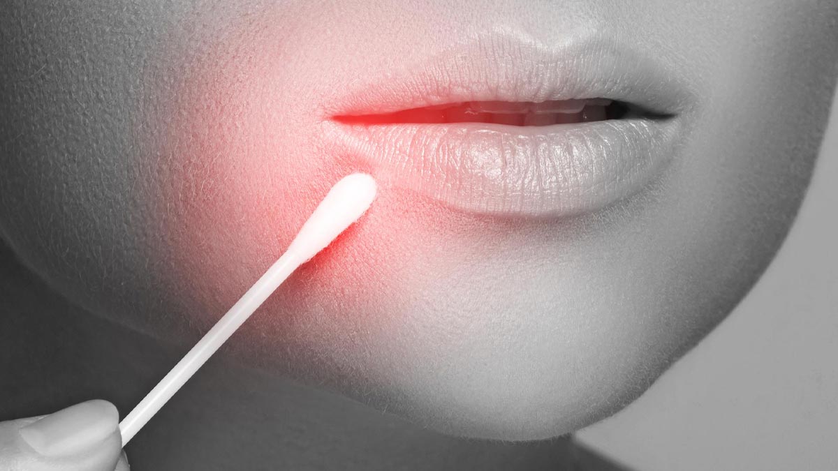 Home Remedies for Blind Pimple 