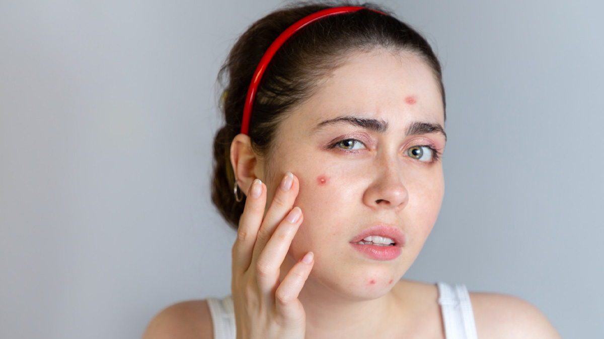 How To Remove Pimples With Lemon And Salt