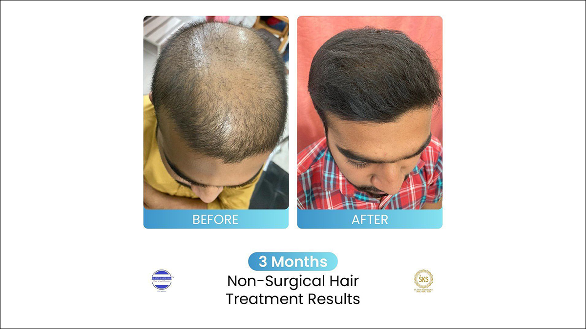 Non Surgical Hair Growth Solution