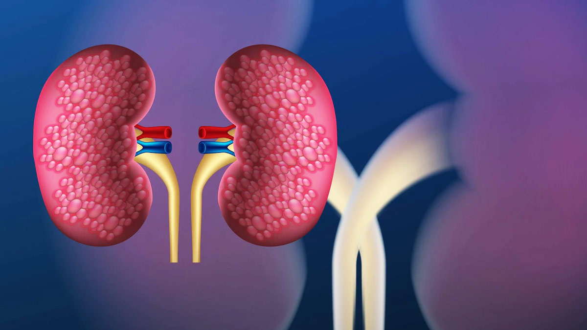  How To Take Care Of Your Kidney Post Transplant, Expert Explains