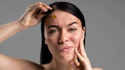 चेहरे से पिंपल्स हटाने के लिए कौन सा तेल लगाएं? 