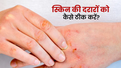 सर्दियों में रूखेपन के कारण स्किन पर दिखती हैं दरारें, अपनाएं ये 5 घरेलू उपाय