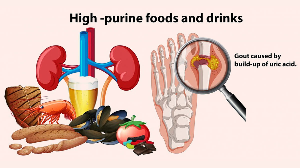 High Uric Acid Levels Can Be Dangerous: Ways To Manage It