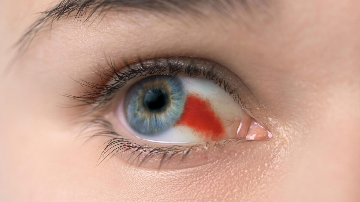 أنواع الأسباب الأعراض وعلاج نزيف العين