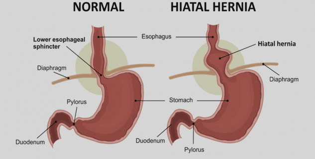 hiatal_hernia