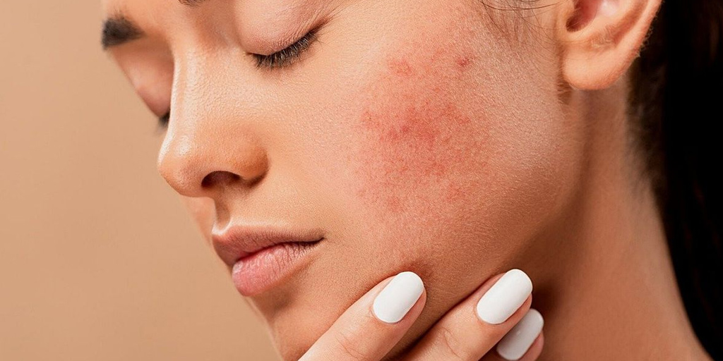 How To Reduce Acne Pain मुंहासों के दर्द से छुटकारा पाने के लिए